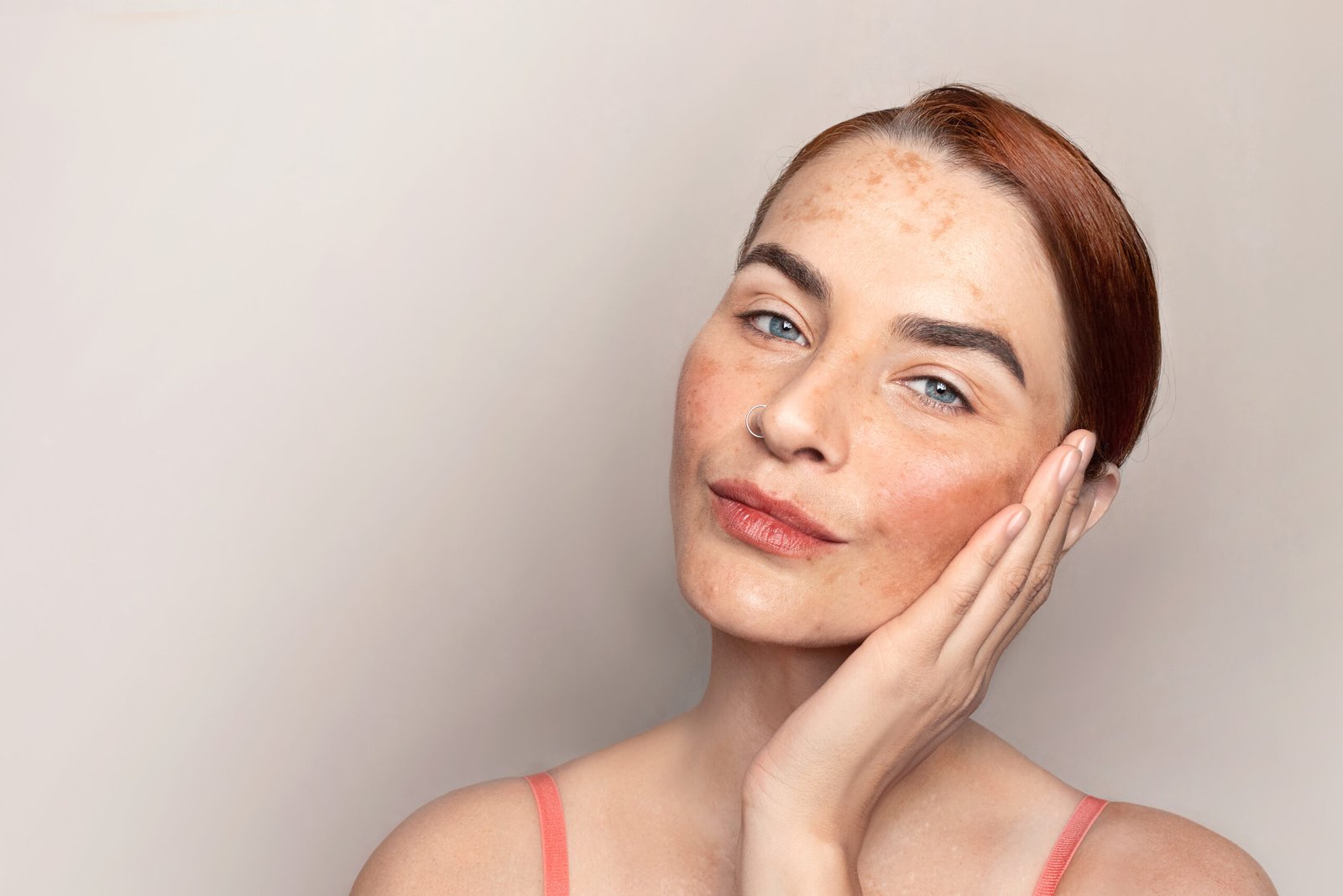 melasma visage causes