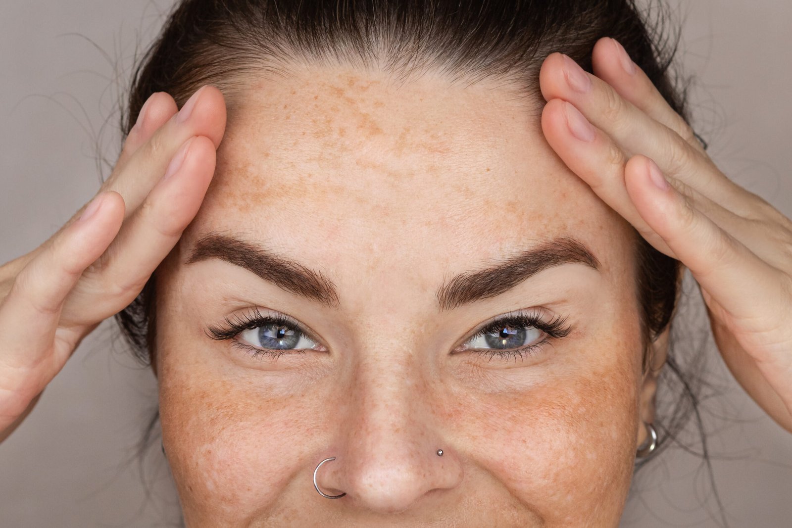 melasma comment empêcher de revenir